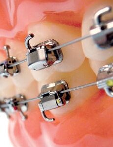 Snaplink Buccal Tubes